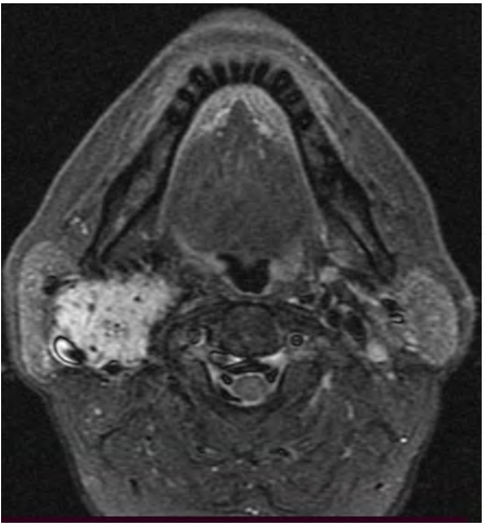 Figure 4: STAIR image showing hyperintense lesion with multiple flow voids.