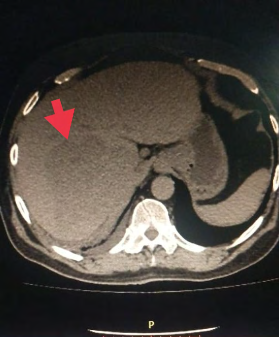 Figure 1: CT abdomen with contrast showing a lesion measuring 11*10cm in segment Vl and Vll of right lobe of liver.