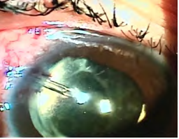 Figure 2: 1st post-operative day picture of Ahmed valve implant.