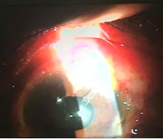 Figure 3: 1week following Ahmed valve implantation.