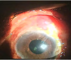 Figure 4: 1month following Ahmed valve implantation.