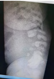 Figure 3: Lateral view abdomen x-ray showed abnormal vertebra.