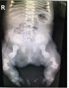 Figure 4: Pelvic x-ray showed phone shape bones.