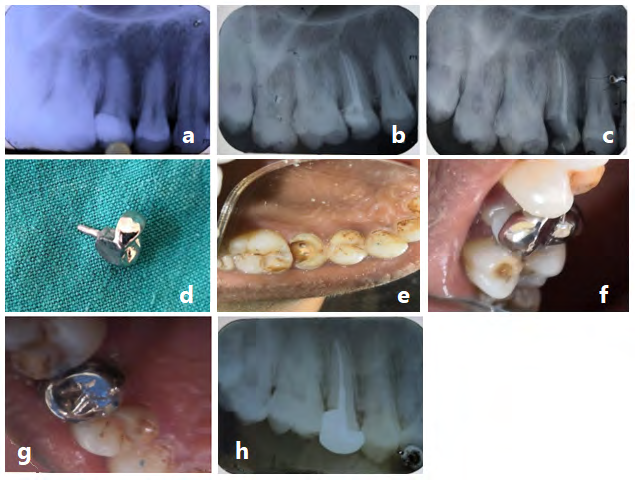 Figure 2: Case 2 Steps of constructing Sharonlay crown for tooth 15 figures a-h.