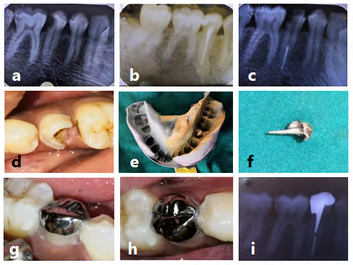 Figure 3: Photos and x-rays for clinical stages of Sharolay crown construction for tooth 45.