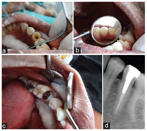 Figure 4: a) Tooth 35 preparation to receive Sharonlay, b) Coronal tooth preparation with buccal and lingual reverse bevel, c) Cemented Sharonlay on the tooth, and d) Postoperative x-ray for the case.