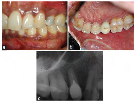 Figure 6: Zirconia Sharonlay restoration on tooth 25 a) buccal view, b) palatal view, and c) Post cementation intraoral periapical (IOPA) on tooth 25 [13].