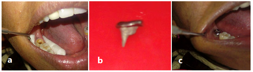 Figure 7: a) Prepared tooth 47 to receive sharonlay, b) Sharonlay casted in Ni-Cr alloy,and c) Sharonlay restoration cemented with GIC luting in the patient mouth after trail [14].