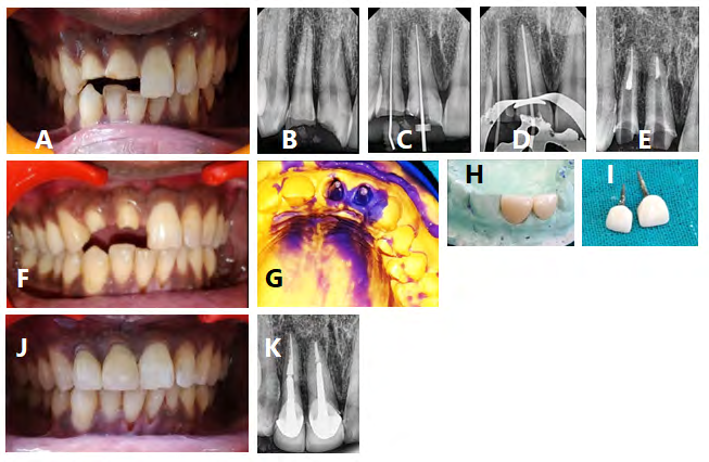 Figure 1: A) Preoperative Photograph, B) Preoperative radiograph, C) Working length was determined D) The master cone gutta percha radiograph was taken E) After a week of obturation, post space was prepared F) The remaining crown structure was prepared G) Impression of the post hole spaces with an overall impression of the upper arch was made for making stone model, H) Fabricated Richmond crowns on teeth 11 and 12 on the stone model, I) Richmond crowns are ready for cementation J) The Richmond crowns were cemented in situ, and K) Post cementation radiograph of the finished Richmond crowns.