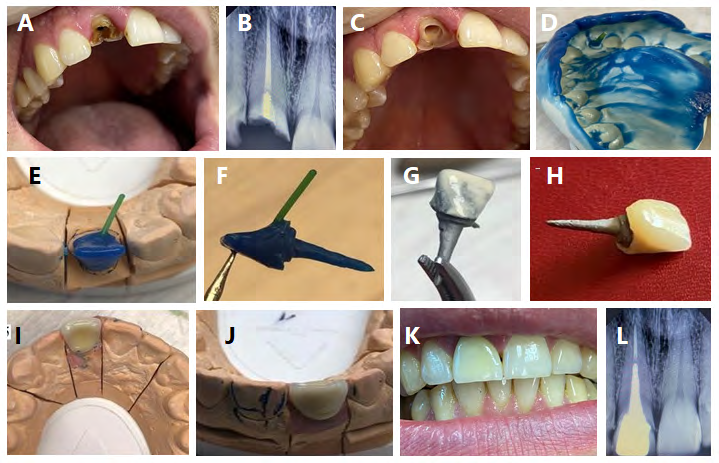 Figure 2: Clinical and laboratory stages of constructing Richmond crown on tooth 11.