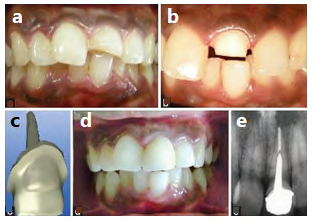 Figure 4: (a) Preoperative intraoral picture: Fractured tooth 21with inadequate overjet and overbite, (b) Preparation of 21 for single-unit all-ceramic post-core-crown restoration, (c) CAD-CAM software designed three-dimensional image of zirconia ceramic restoration, (d) Postoperative view of cemented restoration, (e) Periapical radiograph following cementation of single-unit all-ceramic restoration.