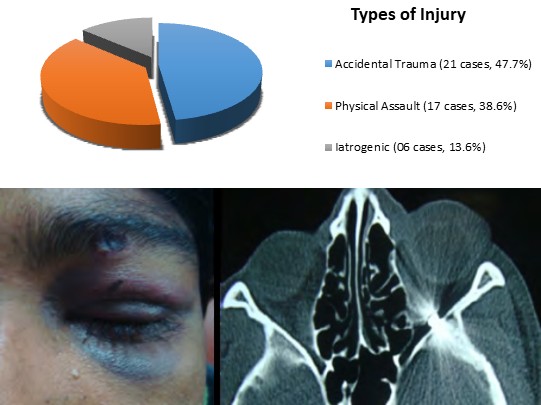 Figure 2: A 16 years old boy presented a contaminated wound in his right upper eyelid. Plain X-Ray revealed that a radiopaque foreign body had lodged in the superior quadrant of the right orbit. A 3.5 cm metallic foreign body had been extracted from the orbit.