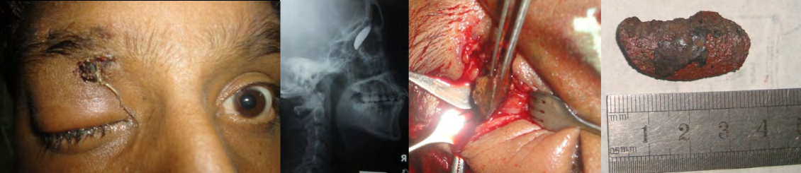 Figure 3: Standard clinical photo showing an 8×10 mm at the medial aspect of the upper eyelid. A hypo-intense mass with surrounding hyper-intense lesion in the right superior orbit on axial image of MRI of the orbit which was suggestive of wooden foreign body. Orbitotomy was made and a cylindrical shaped wooden foreign body was extracted from the orbit.