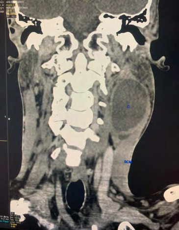 Figure 1: ** CT scan of neck coronal view.
