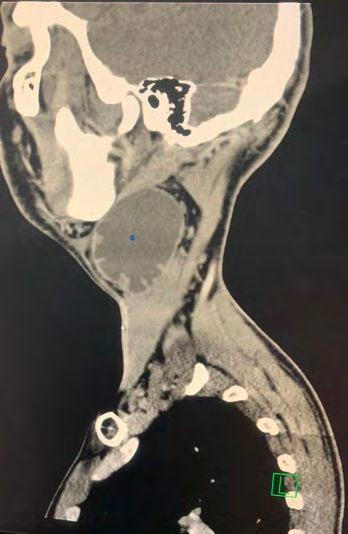 Figure 2: ** CT scan of neck sagittal view.