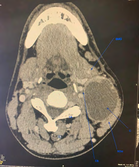 Figure 3: ** CT scan of neck axial view.