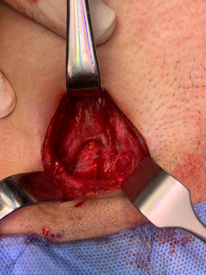 Figure 7: Intra-operative view; digastric muscle.
