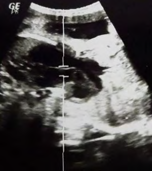 Figure 2: It shows two heart with communication between.