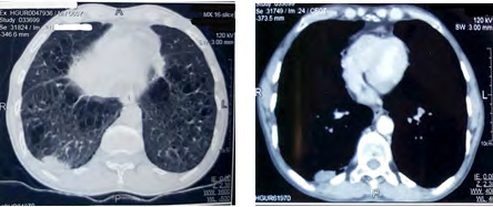 Figure 3: CT scan (Lung window and Bony window showing reduction in the size of mass responding to ATT.