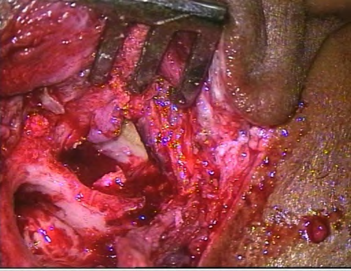 Figure 1: Pre-operative images showing right grade 4 facial nerve palsy with bells sign positive.