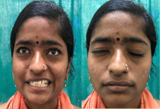 Figure 3: Post-operative findings-facial nerve showed steady improvement with return to normal function at the end of 4th week.