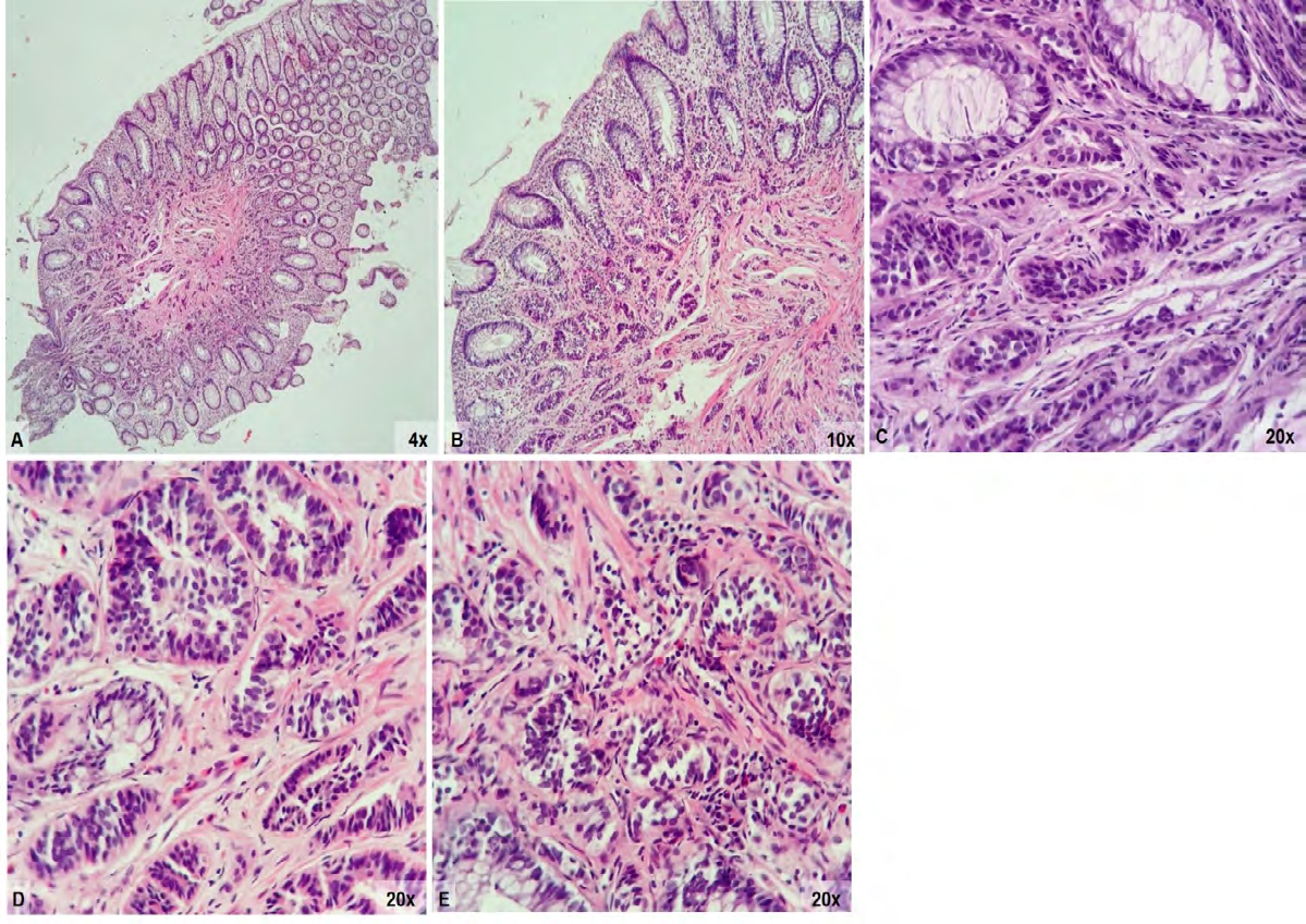 Figure 1: Histopathological features (H&E) A and B: Fragment obtained by mucosectomy of rectal NET limited to the mucosa/ submucosa; C: NET of the rectus consisting of cell nests, sketching glandular lumens; D and E: Neoplastic cells with regular, hyperchromatic with speckled chromatic, rounded or ovoid nuclei, and scarce eosinophilic cytoplasm, with low mitotic index.