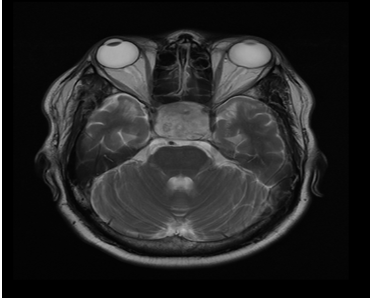 Figure 1: MRI sagittal T2 slice showing the pituitary adenoma occupying the entire sella turcica.