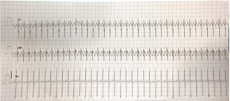 Figure 2: Electrocardiogram showing the typical “saw tooth” pattern of atrial flutter with 3:1 atrioventricular conduction in lead ll, after administering adenosine.