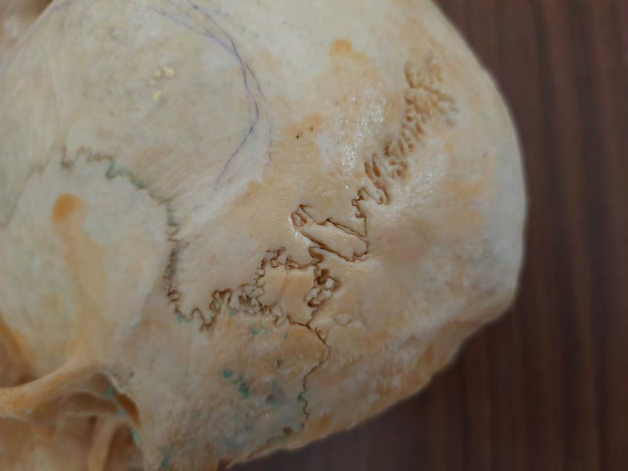 Figure 1: Photograph from posterolateral view of skull showing Wormian bone in left asterion.