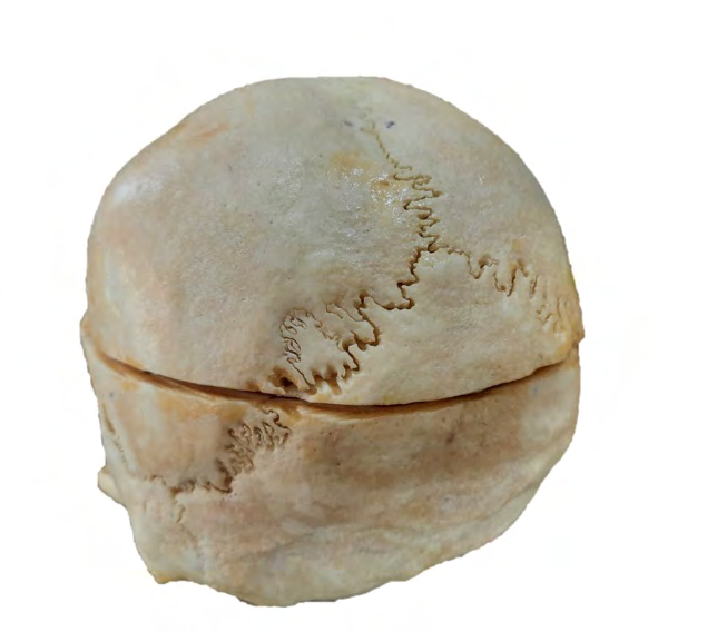 Figure 3: Wormian bone in the left lambdoid suture.