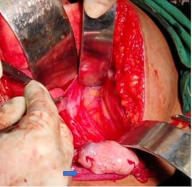 Figure 1: Left side fallopian tube and ovary saved
