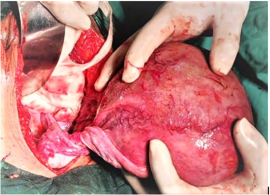 Figure 2: Myomatous Non - Gravid Uterine torsion and Congenital Absence of cervix.