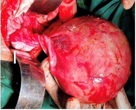 Figure 4: Left side Fallopian tube and Ovary in the pedicle of torsion Frozen section was sent and was suggestive of leiomyoma with no evidence of malignancy. Patient withstood the procedure well. Post op monitoring was done and was started on higher injectable antibiotics