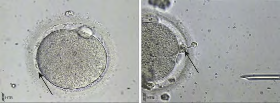 Figure 3: Courtesy ref no-2-Debris from the degenerated gap junctions and corona cell pulled under the zona pellucida (arrow) resulting from failure of its gap junction degeneration. (From Dozortsev DI, unpublished data.) Like, a follicle that is about to undergo demise does not rupture, as well as the egg has resumption of meiosis secondary to cumulus cell demise in addition to acquiring a postmature look on retrieval of oocyte [unpublished Data Dozortsev DI] (Figure4).This kind of post maturity all the time represents a local process, like a post mature egg can get obtained by the side of the normal looking oocytes, in case of LH being well repressed [unpublished Data Dozortsev DI] (Figure 4).
