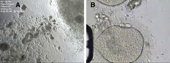 Figure 4: Courtesy ref no-2-Findings from the follicular aspirate of a patient with progesterone rising to 2 ng/mL two days before the trigger. (A) An oocyte-cumulus complex has a clumpy and degenerating appearance compared with the one above. (B) An oocyte with postmature features from that degenerating oocyte-cumulus complex.