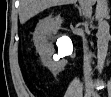 Figure 1: Non-contrast CT scan showed partially staghorn stone in the right kidney.