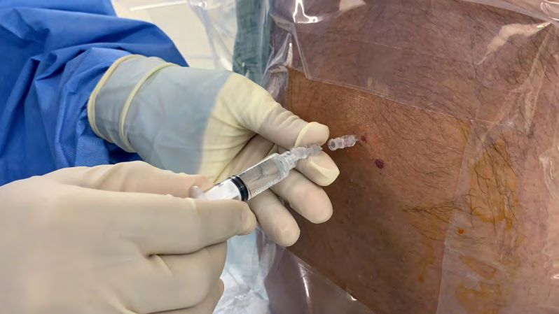 Figure 2: spinal anesthesia prior the surgery.