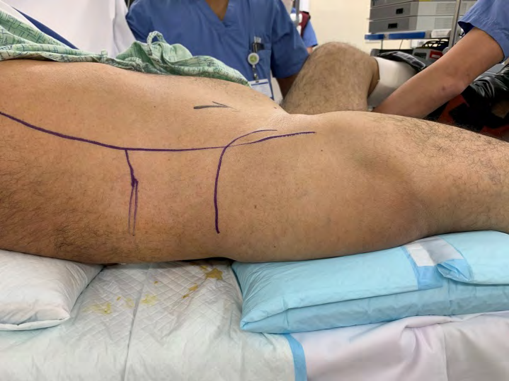 Figure 3: positioning the patient, 25 degree tilted to the left side with elevation of the gluteal area and the back, leaving the flank area free for easier mainpulation.