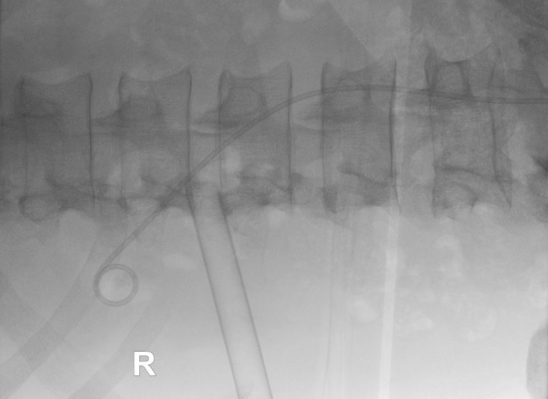 Figure 5: fluoroscopy at the end of the procedure showing no residual stone, the JJ stent in place and the Amplatz sheath.
