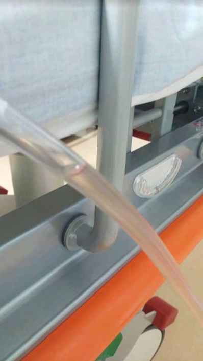 Figure 6: Clear urine through the bladder catheter tube after the surgery.