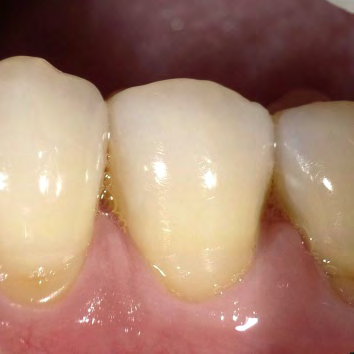 Figure 5: Baseline postoperative photograph of BL #20.