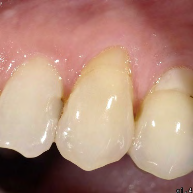 Figure 6: Photograph of BL #20 at 6 months recall.