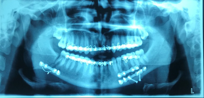 Figure 2: Post-operative Orthopantomogram.