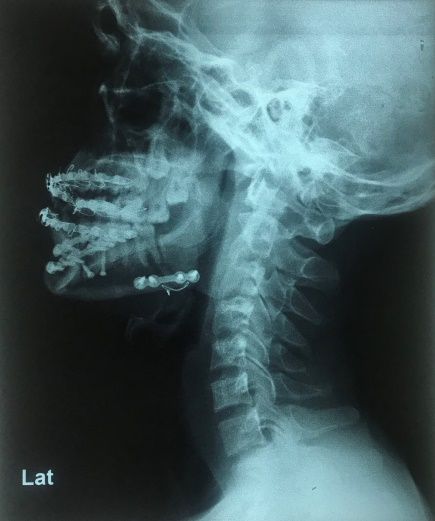 Figure 3: Lateral View of Neck X Ray.