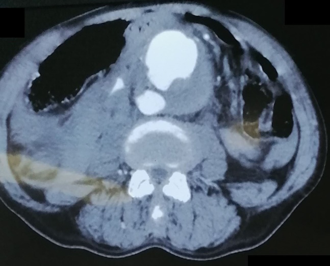 Figure 1: Axial section of an abdominal aorticaneurysm ruptured into the retroperitoneum and the inferior veina cava.