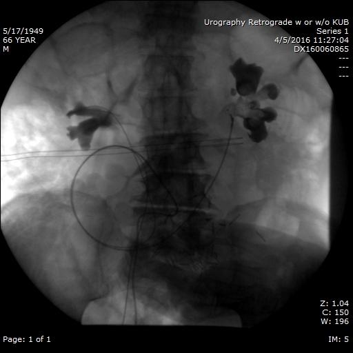 Figure 1: Retrograde pyelogram at the time of stent exchange. Multiple filling defects are seen within the left renal pelvis representing blood clot. As blood entered the ureter via the fistula, it traveled retrograde and collected in the renal pelvis. Additionally, no contrast was seen entering the fistula or artery either because the fistula had either already clotted off, or the pressure within the fistula was greater than that of our injecting pressure.
