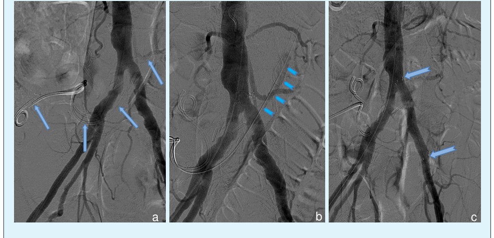 Figure 2: Angiogram series showing the ureteral stents in place with the arrows following the left stent (a.), followed by a provocative angiogram (b.) that shows the aorta with contrast entering the left ureter (ribbon arrows), and after demonstration of the UAF, a covered stent was placed within the left common iliac artery (split-tail arrows) spanning the distance of the fistula (c.).
