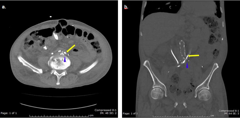 Figure 3: Non-contrast CT of the abdomen and pelvis. a.) Axial view with the abdominal window shows the left ureteral stent passing (arrow) over the left common iliac artery (arrow head). b.) Coronal view in the bone window shows more clearly the stent (arrow) coursing over the iliac artery (arrow head). There is also significant atherosclerosis of the abdominal aorta and iliac arteries. This allows for 2 rigid and relatively fixed environments, which over time sets the stage for fistula formation.