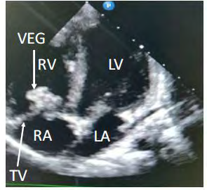 Figure 1: 2D echocardiography-apical four chamber view- tricuspid valve infective vegetation. (RA-Right Atrium, RV-Right Ventricle, LA-left atrium, LV-Left Ventricle, VEG- Vegetation, TV-Tricuspid valve).