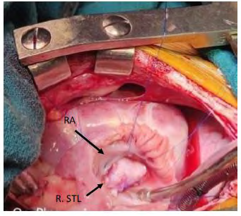 Figure 4: intraoperative-Right atrium opened- visualization of tricuspid valve-reconstruction of septal and anterior tricuspid valve leaflets with autologous unfixed pericardium. (RA= right atrium, R. STL= reconstructed septal tricuspid leaflet).